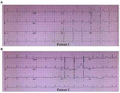 Novel SCN5A and GPD1L Variants Identified in Two Unrelated Han-Chinese Patients With Clinically Suspected Brugada Syndrome